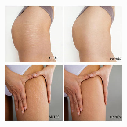 Cryo Thermo - Crema tensora de celulitis para el cuerpo